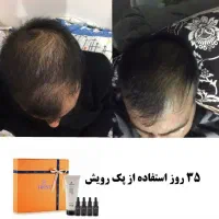 درمان قطعی و تضمینی ریزش شدید مو ( مقطعی و سکه ای)|آرایشی، بهداشتی، درمانی|رشت, حاجی آباد|دیوار