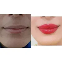 تزریقات زیبایی