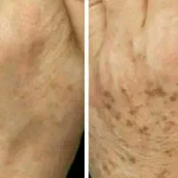 چاقی صورت ، حجم دهی