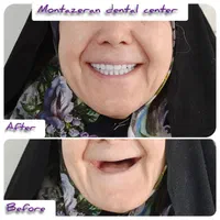 دندان مصنوعی/ ضمانتی / ایتالیایی/ جوان پسند|خدمات آرایشگری و زیبایی|مشهد, امام رضا (ع)|دیوار
