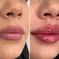 تخفیف ژل و بوتاکس ویژه فقط برای فردا|خدمات آرایشگری و زیبایی|مشهد, شهید معقول|دیوار