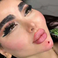 تزریق تخصصی ژل کانتورینگ صورت وزاویه فک وفیشیال|خدمات آرایشگری و زیبایی|کرج, گلشهر|دیوار