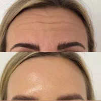 آنزیم و مزو تراپی. .فیلر و بوتاکس