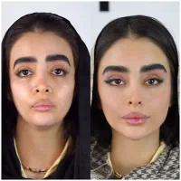 جشنواره تزریق ژل و بوتاکس زاویه فک لب لیفت