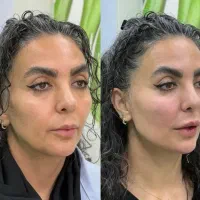 تزریق ژل و بوتاکس و مادلینگ عربی|خدمات آرایشگری و زیبایی|کرمانشاه, |دیوار