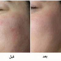 سرم گیاهی ضدجوش و لک|آرایشی، بهداشتی، درمانی|سلماس, |دیوار