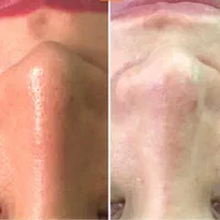 پاکسازی و روشنسازی و جوانسازی پوست|خدمات آرایشگری و زیبایی|مشهد, شهید فرامرز عباسی|دیوار