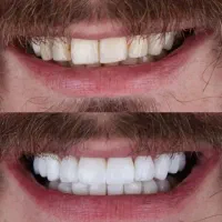 تخفیف ویژه کامپوزیت و خدمات دندانپزشکی|خدمات آرایشگری و زیبایی|اسلام‌شهر, باغ فیض|دیوار