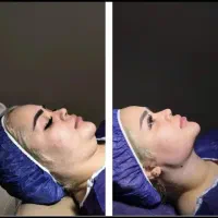 مرکزلیپوساکشن و ساکشن غبغب و زاویه سازی توسط جراح|خدمات آرایشگری و زیبایی|مشهد, سناباد|دیوار