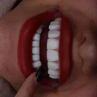 کامپوزیت لمینت بلچینگ روکش بلفارو غبغب لیفت صورت