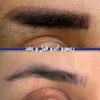 ریموو تک جلسه  با تخفیف ویژه|خدمات آرایشگری و زیبایی|تربت جام, پاسداران|دیوار