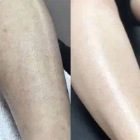 مرکز لیزر‌ موهای زائد با دستگاه شاتی(۸جلسه تضمینی)