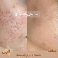 مزونیدلینگ حرفه‌ای در کلینیک زیبایی/هاشمیه|خدمات آرایشگری و زیبایی|مشهد, چهارچشمه|دیوار