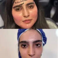 آموزش وخدمات تزریق تخصصی ژل وبوتاکس ،مزوتراپی