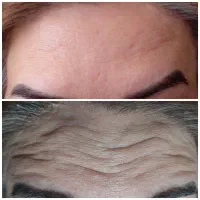 فیشیال مردانه تخصصی + بوتاکس و مزوتراپی|خدمات آرایشگری و زیبایی|رفسنجان, |دیوار