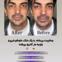 لیزر موهای زائد به مدت محدود فول ۴۹۰|خدمات آرایشگری و زیبایی|ارومیه, |دیوار