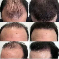 باریزش موهات خداحافظی کن