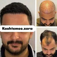 کاشت مو و ابرو