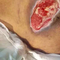 درمان نوین انواع زخم دیابتیک و بستر و جراحی و بخیه|خدمات آرایشگری و زیبایی|صومعهسرا, |دیوار