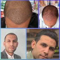 کاشت مو و ابرو|آرایشگاه و سالن‌های زیبایی|تهران, جردن|دیوار