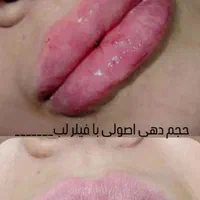 تزریق ژل بوتاکس