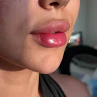 تزریق ژل و بوتاکس،فیلر بادی،تزریق چربی،ساکشن