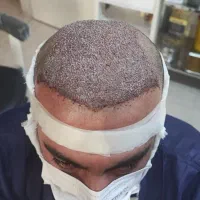 کاشت مو و ابرو در مازندران با تراکم بالا تضمینی|خدمات آرایشگری و زیبایی|ساری, |دیوار