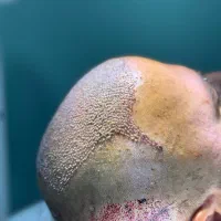 کاشت مو و ابرو