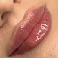 تزریق ژل و بوتاکس با تخفیفات بی نظیر به مدت محدود|خدمات آرایشگری و زیبایی|مشهد, فرهنگ|دیوار