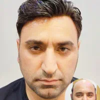 پروتز مو|آرایشی، بهداشتی، درمانی|تهران, سلسبیل جنوبی|دیوار