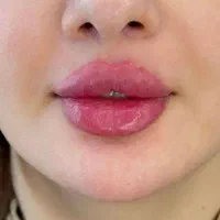تزریق ژل لب و گونه و چانه.. (جشنواره)درمطب فقط499ت|خدمات آرایشگری و زیبایی|اصفهان, باغ زیار|دیوار