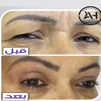 تخفیف ویژه بلفاروپلاستی