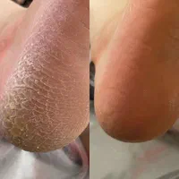 کفسابی و درمان گوشت فرو رفته در گوشت
