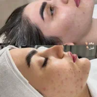 فیشال پوست و کاشت ناخن تضمینی تخفیف یلدایی