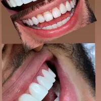 جشنواره کامپوزیت لمینت  بلیچینگ  پالیش دندان|خدمات آرایشگری و زیبایی|تهران, شهرک ولیعصر جنوبی|دیوار