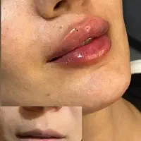 تخفیف های باور نکردنی ژل و بوتاکس