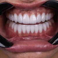 ساخت‌ دندان‌ مصنوعی با هزینه مناسب زیر نظر متخصص