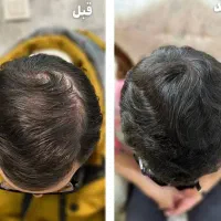 درمان قطعی ریزش مو و رد مجدد مو با پکیج درمانی H3|خدمات آرایشگری و زیبایی|شاهین‌شهر, خانه کارگر|دیوار