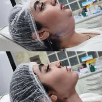 ژل بوتاکس عمل بینی ساکشن چربی در کلینیک بهنود|خدمات آرایشگری و زیبایی|تبریز, |دیوار