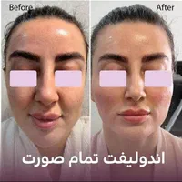 اندولیفت.لیپوفیس.ساکشن غبغب با اولترا زد|خدمات آرایشگری و زیبایی|مشهد, سناباد|دیوار