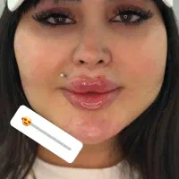 جشنواره تخفیفات باورنکردنی یک هفته (ژل،بوتاکس)
