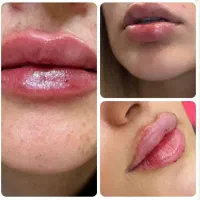ژل و بوتاکس فیلر مزو تخفیف 40%