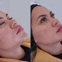 هایفو و لاغری و جوانسازی توسط پزشک متخصص|خدمات آرایشگری و زیبایی|شیراز, ارم|دیوار