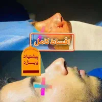 جشنواره رینوپلاستی(۳۹ میلیون اقساط۶ ماهه)