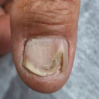 درمان ناخن تو گوشت رفته و قارچ گرفته|آرایشی، بهداشتی، درمانی|ارومیه, |دیوار