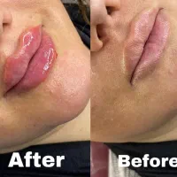 تزریق ژل وبوتاکیس|خدمات آرایشگری و زیبایی|بجنورد, |دیوار