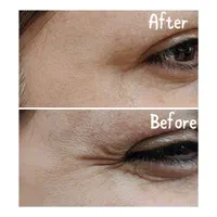 لیزر هایفو ژل بوتاکس ریمو تتو|خدمات آرایشگری و زیبایی|بوشهر, |دیوار