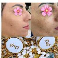 کرم سفید کننده صورت وبدن 10درجه سفیدی|آرایشی، بهداشتی، درمانی|مشهد, کوه سنگی|دیوار