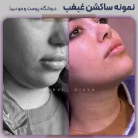 ساکشن غبغب،بلفاروپلاستی،تزریق چربی+قیمت|خدمات آرایشگری و زیبایی|قم, باجک یک|دیوار