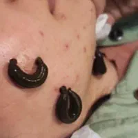 امبدینگ حجامت طب سوزنی بادکش زالو فصد خون|خدمات آرایشگری و زیبایی|اصفهان, باغ زرشک|دیوار